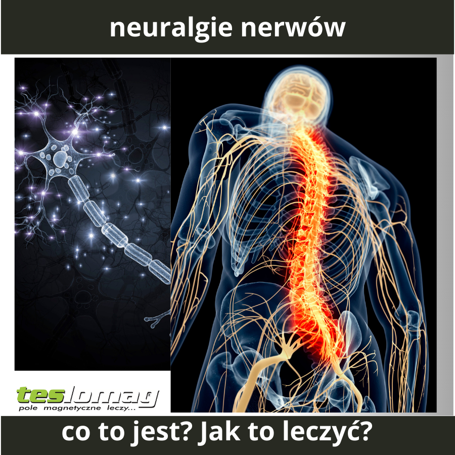 Neuralgie (nerwobóle)