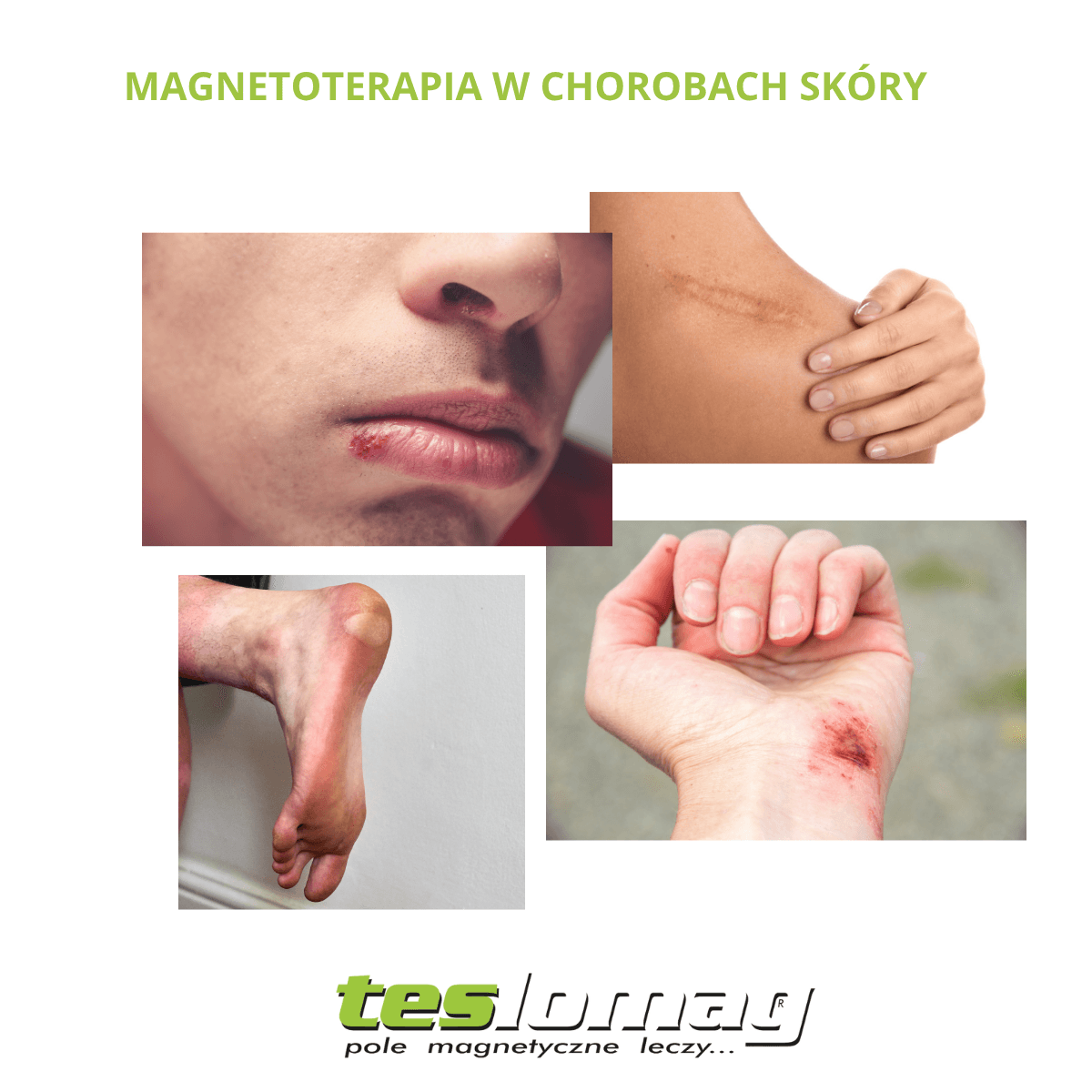 Magnetoterapia w chorobach skóry